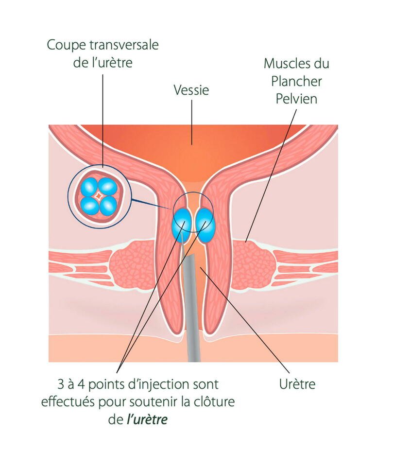 Bulkamid - incontinence urinaire